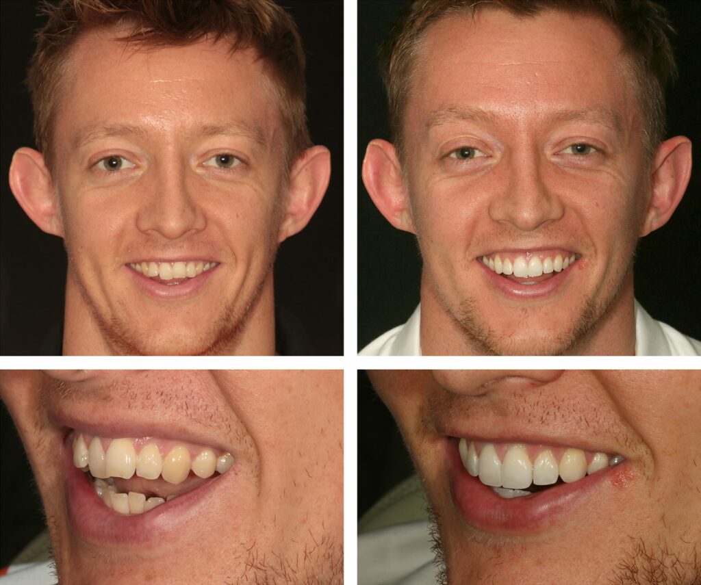 Before and after