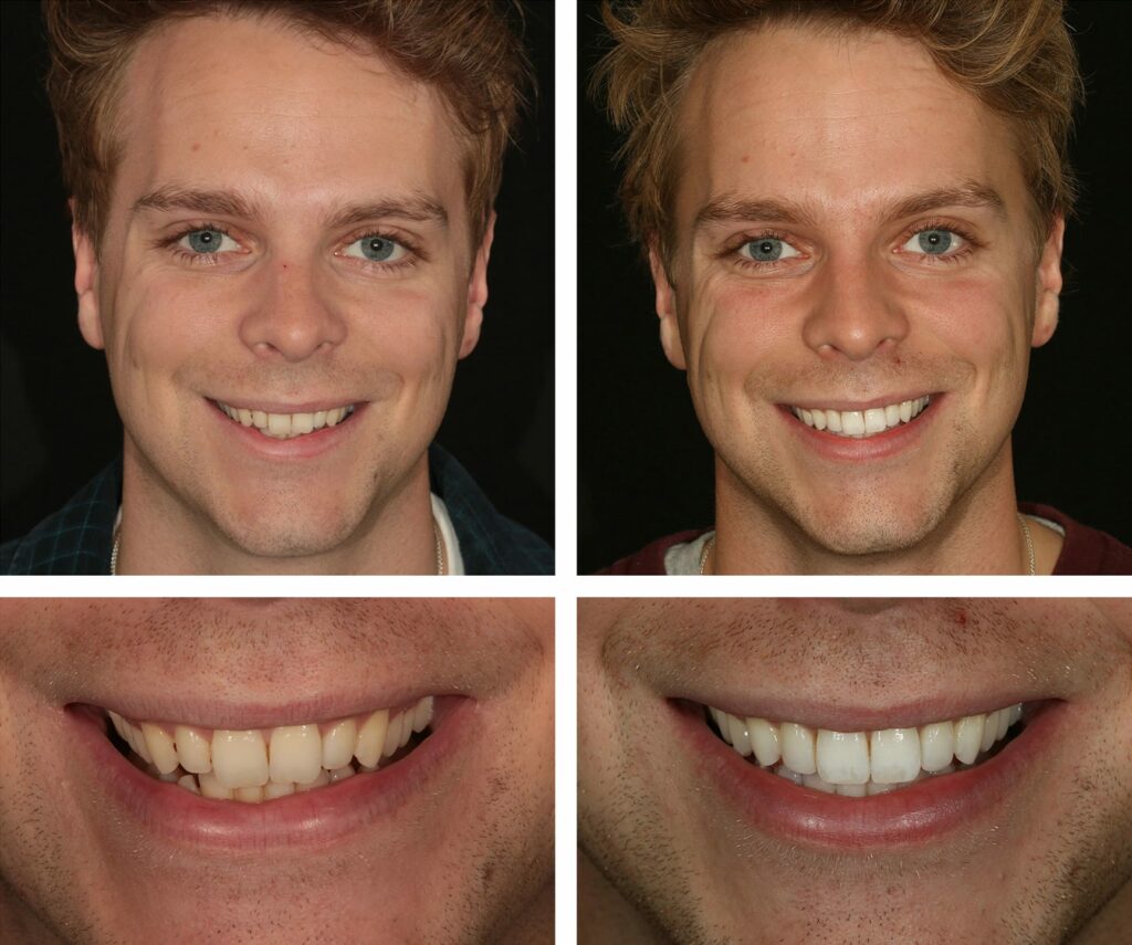 Before and after