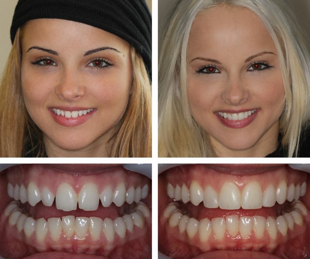 Before and after
